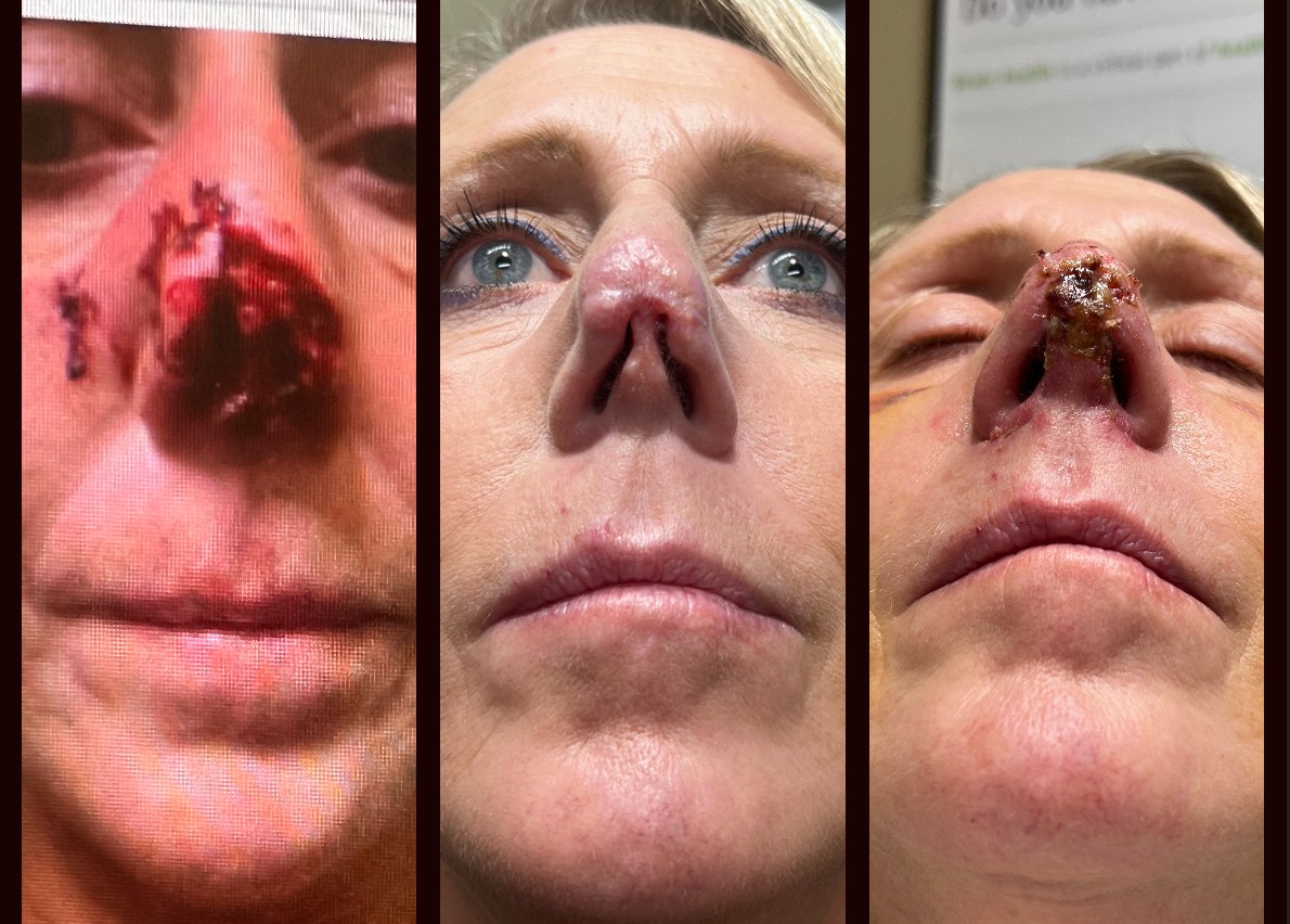 Surgical Before & After defect reconstruction on nose before and after