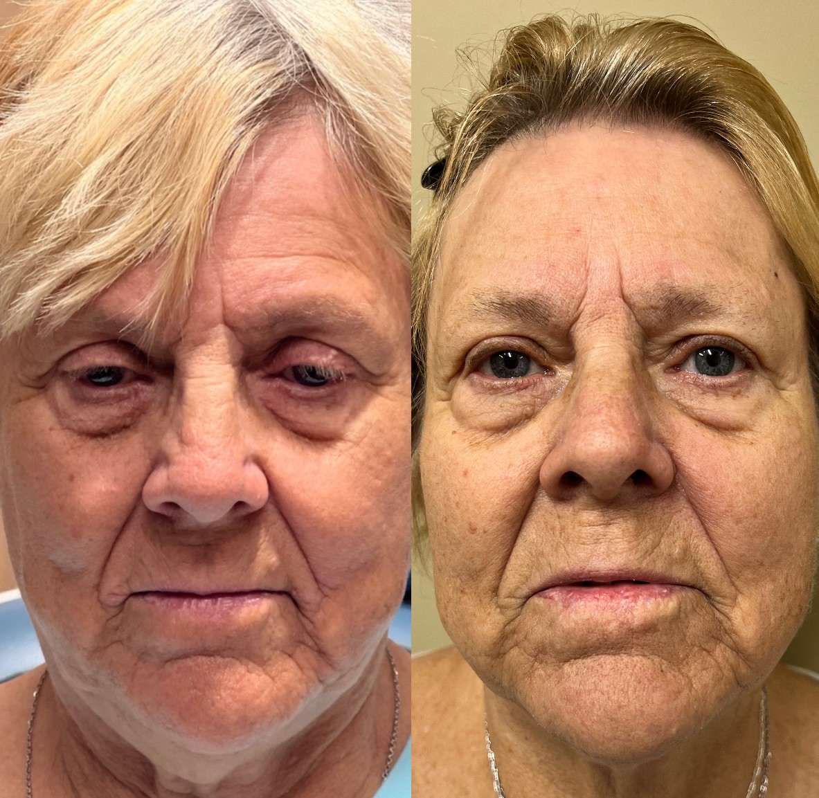 Surgical Before & After eyelid and brow lift