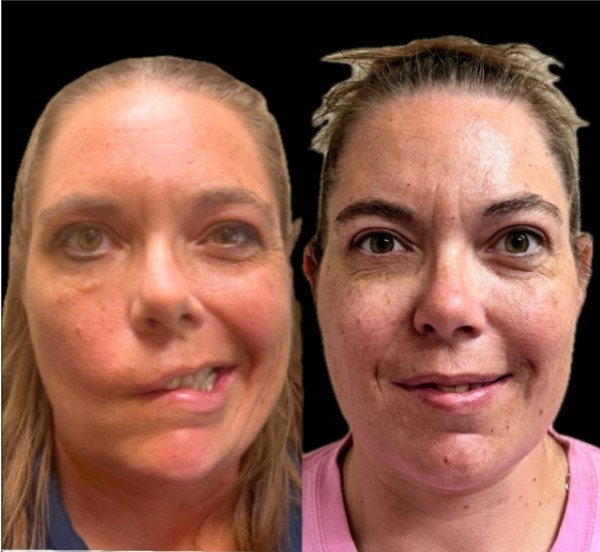 Surgical Before & After facial paralysis before and after surgery