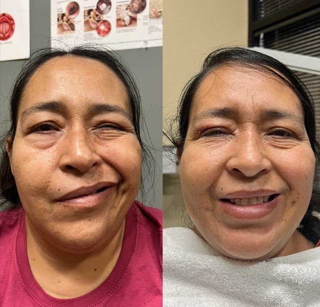 Surgical Before & After facial paralysis before and after