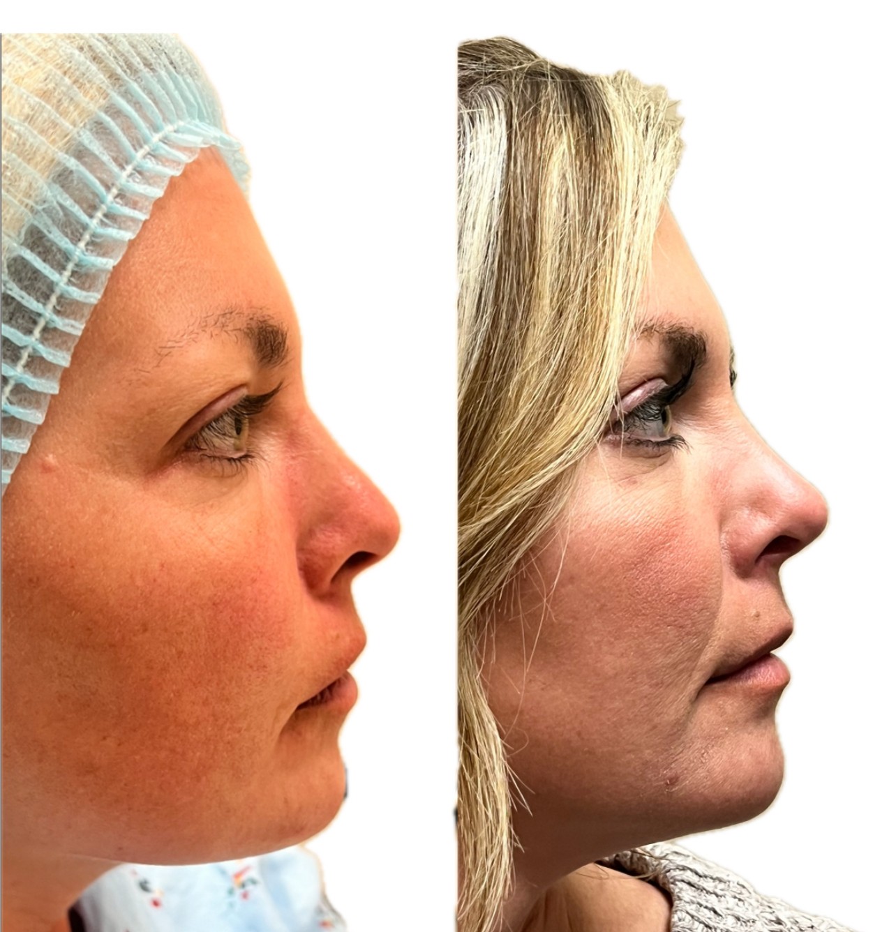 Surgical Before & After nose surgery before and after