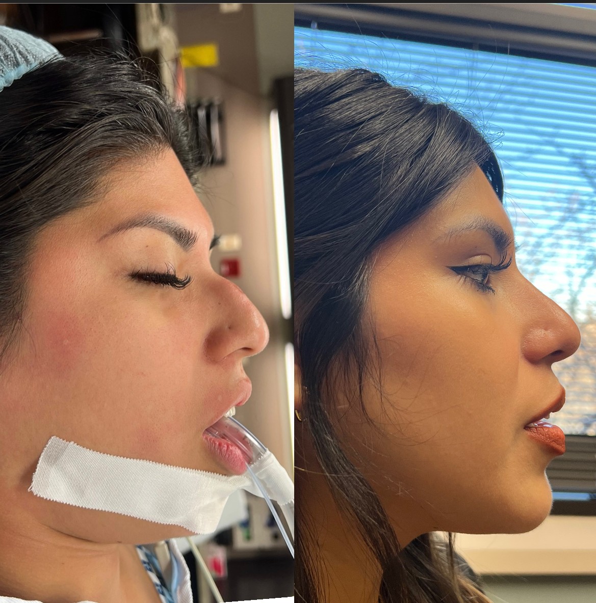 Surgical Before & After nose surgery before and after