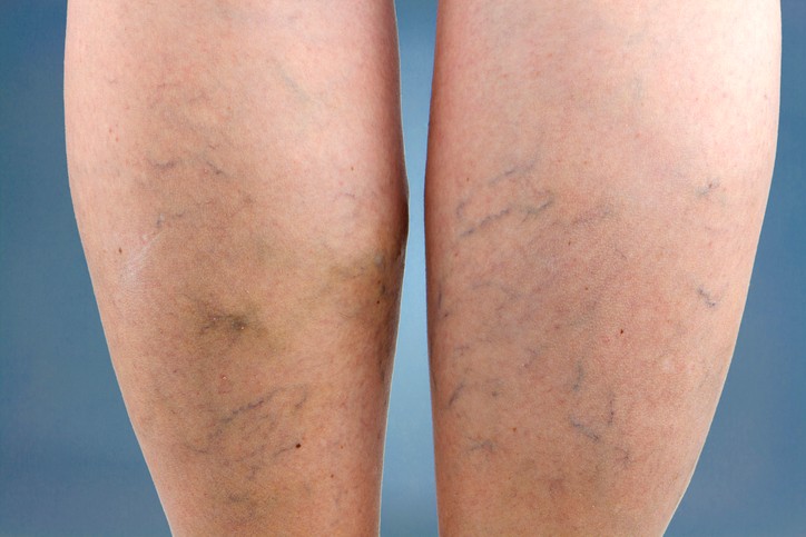 image of spider veins