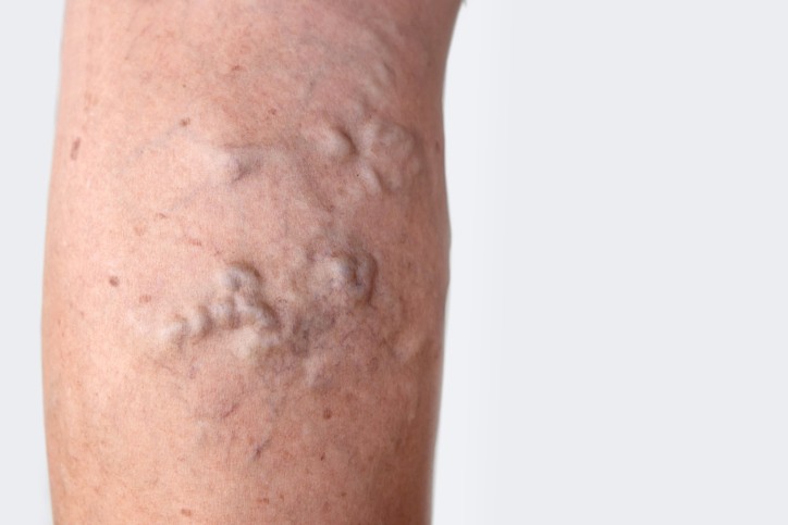 vericose veins